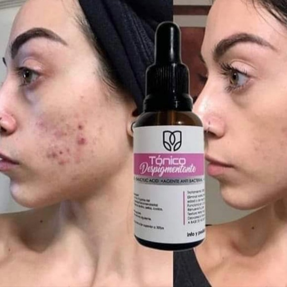 LB Tónico Despigmentante🇨🇴* Eliminador de manchas* Removes dark spots + … - Picture 4 of 15